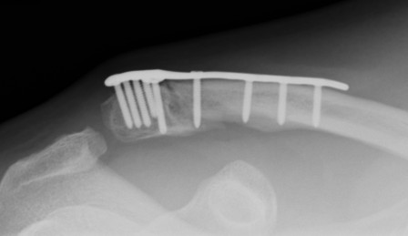 Lateral Clavicle Plate